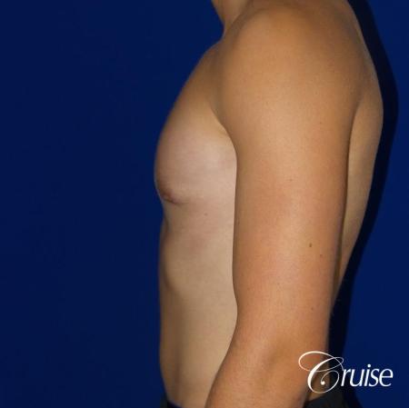 Mild Gynecomastia -Areola Incision - After Image 3