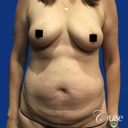 Best tummy tuck incisions orange county - Before Image 1
