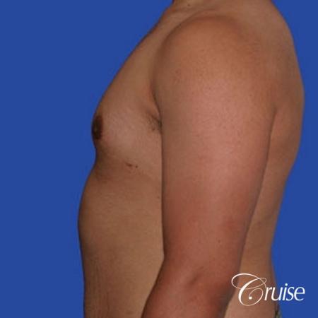 minor gyne young adult with best scars - After Image 2