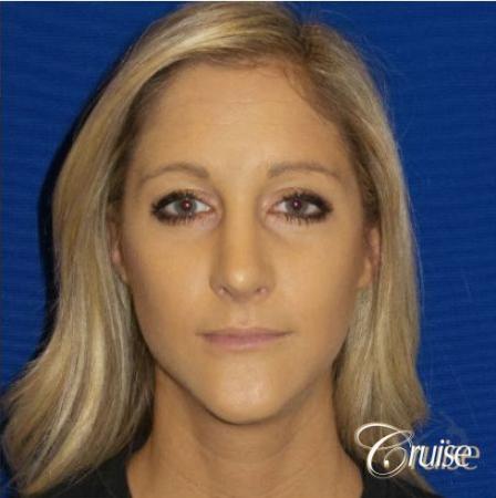 Best Rhinoplasty results Newport Beach CA - After Image 1