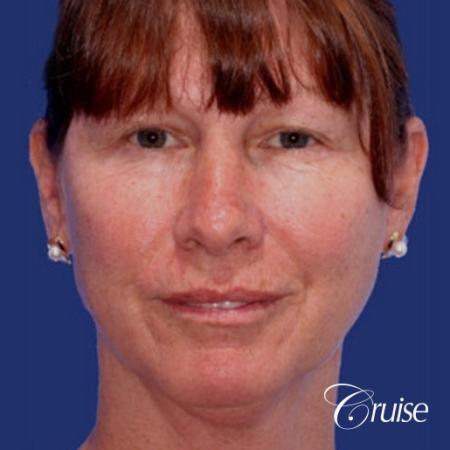 52 year old with chin augmentation and facelift - Before Image 1