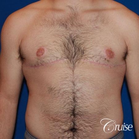 20 with Gynecomastia and puffy nipple - After Image 1