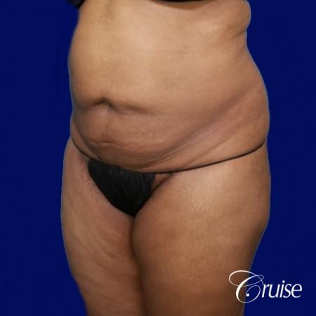 Liposuction Flanks - Before Image 3