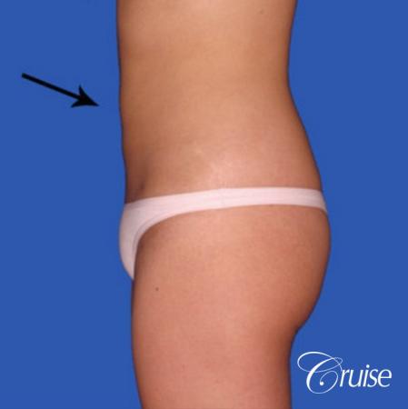best before and after liposuction stomach and love handles - After Image 2