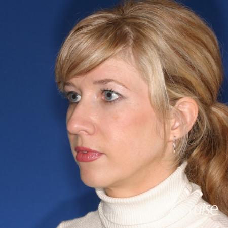 female patient with best chin implant scar - Before Image 3