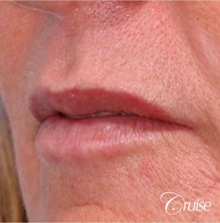 best filler pictures in Newport Beach - Before Image 2