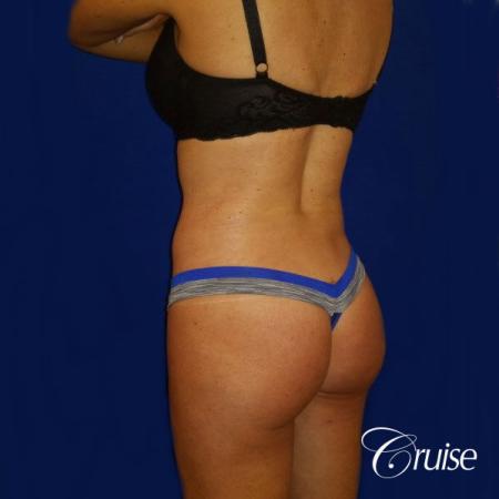 Brazilian Butt Lift Dr. Cruise - After Image 3