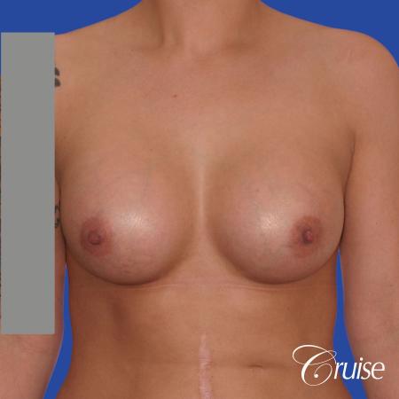 Breast Augmentation - After Image 1