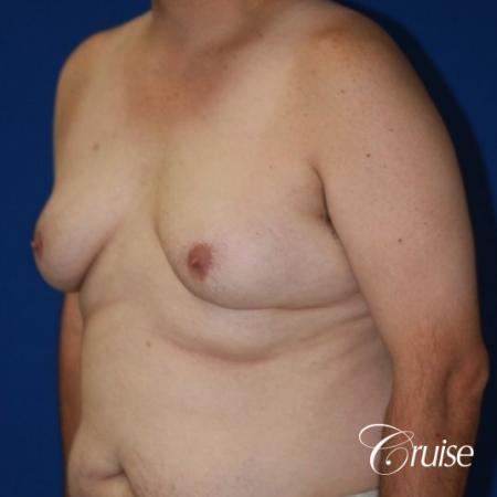 male breast severe gynecomastia free nipple graft anchor - Before and After Image 3