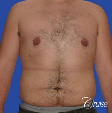 male liposuction abdomen flanks with Gynecomastia - After Image 1