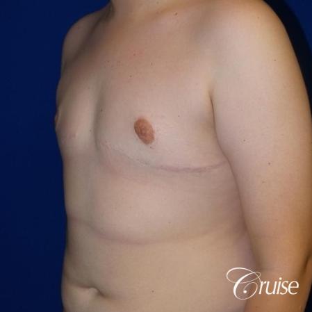 young boy with gynecomastia during puberty gets surgery - After Image 2