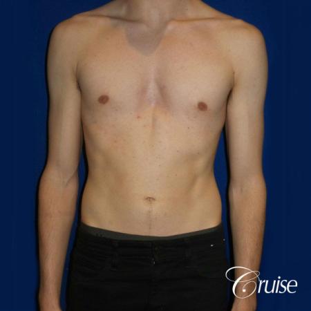 Top Gynecomastia Specialist Dr. Cruise - After Image 1