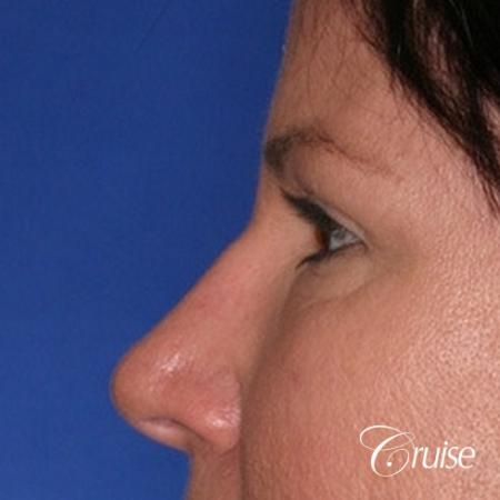 best plastic surgery on upper eyelids - After Image 2