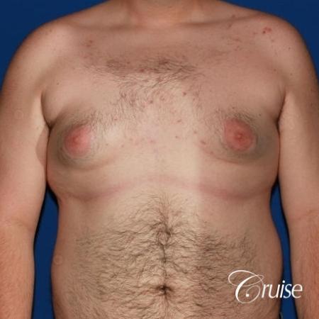 moderate gynecomastia with pointy man boobs - Before Image 1