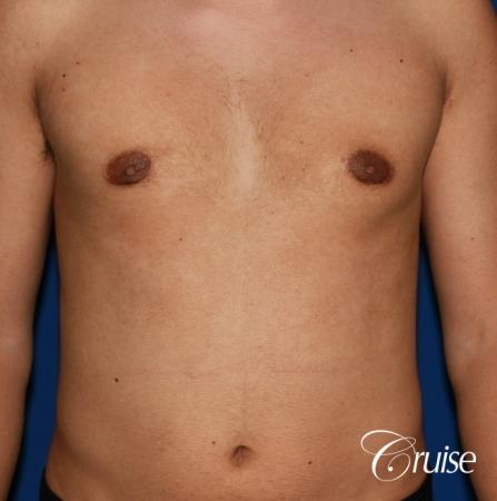 mild gynecomastia before and after with puffy nipple - After Image 1