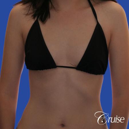 Breast Augmentation - Before and After Image 3