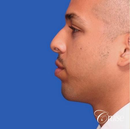 male patient with best pictures of chin implant - After Image 2