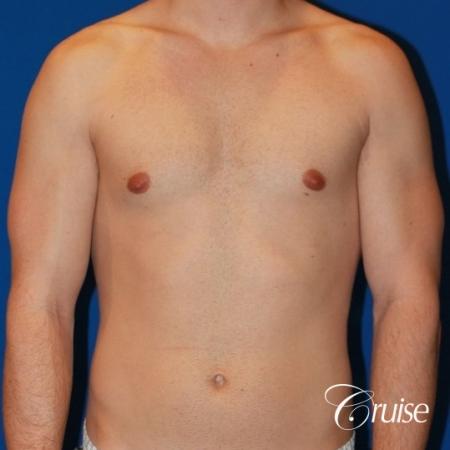 32 yo with Gynecomatia and Puffy Nipple - Before Image 1