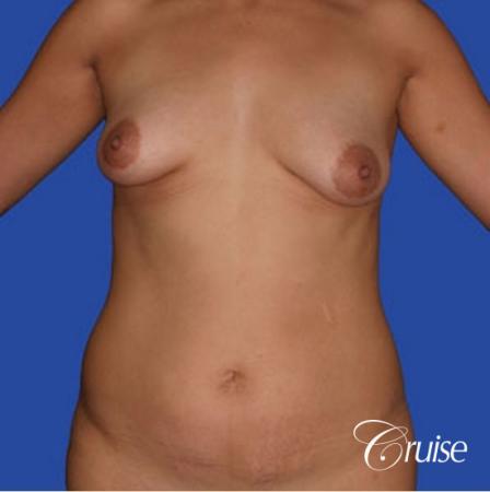 mommy makeover with silicone lollipop lift with best scars - Before Image 1