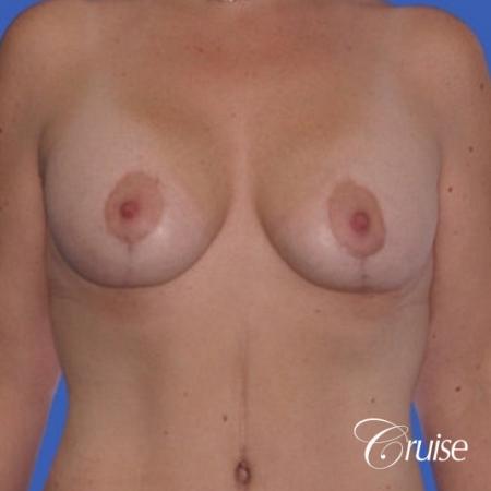 best photos of breast lift anchor on 39 yr old - After Image 1
