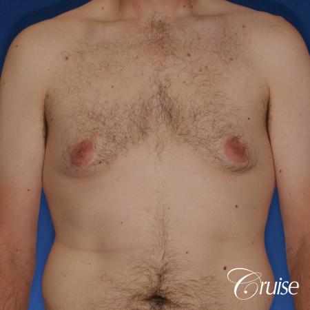 adult male with moderate gynecomastia gets donut lift - Before Image 1