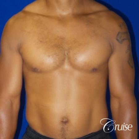 gynecomastia caused by testosterone - After 1