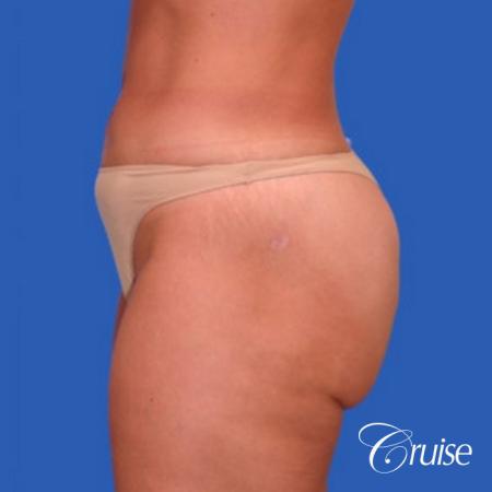 best liposuction abdomen flanks medial and lateral thighs dramatic - After Image 2