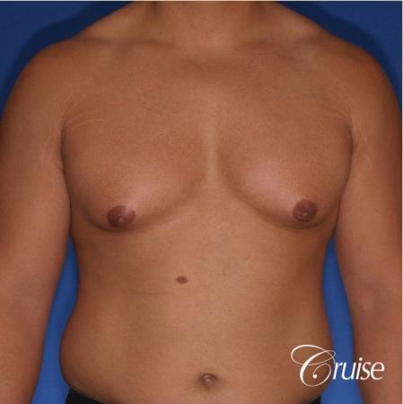 donut lift gynecomastia moderate adult - Before Image 1