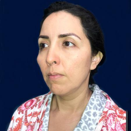 Liposuction of Neck/Jawline - Before and After Image 3