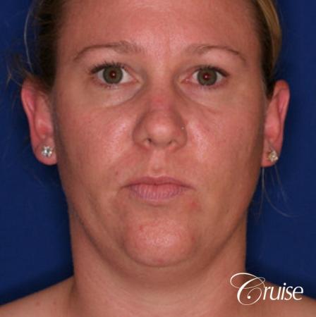 best liposuction neck and jawline for double chin - Before Image