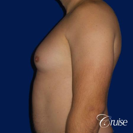 male breast reduction surgery - Before and After Image 3