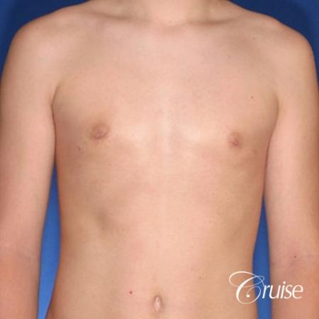 teenage gynecomastia with puffy nipple - After 1