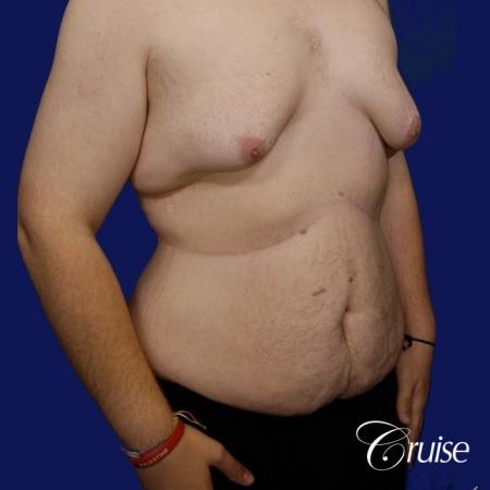 severe gynecomastia - Before Image 3