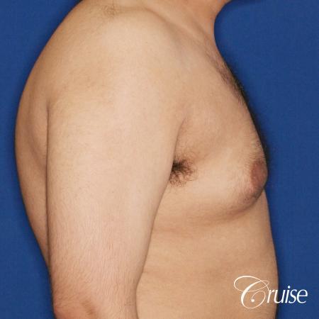 best scar on 32 gynecomastia patient - Before Image 4