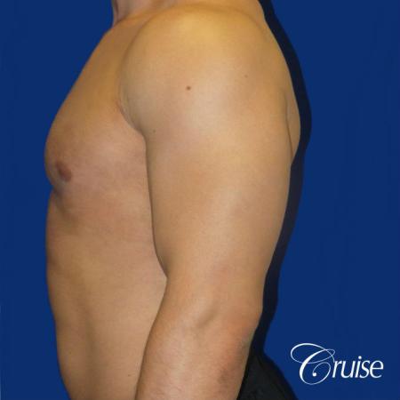 Type 1 Body Builder Puffy Nipple Correction - After 3