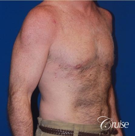 extended pa incision on gynecomastia patient - After Image 3