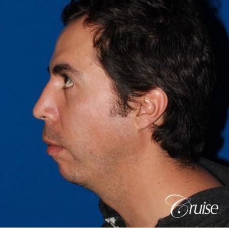 male patient with large chin augmentation - Before Image 2