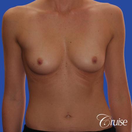 Breast Augmentation - Before Image 1