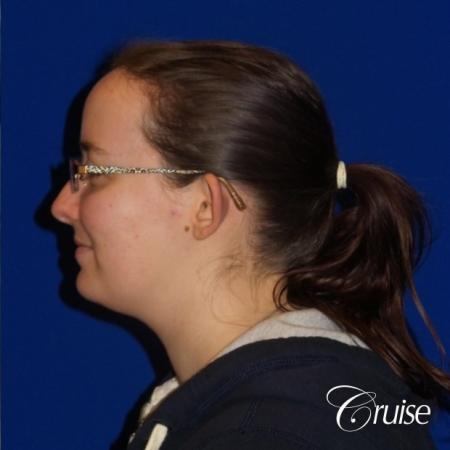 Otoplasty And Earlobe Repair: Patient 2 - Before and After Image 3