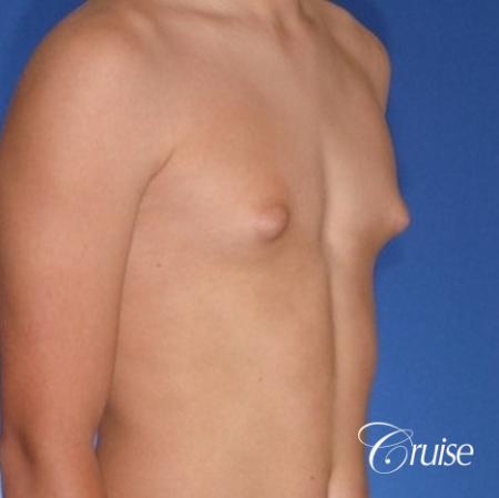teenage gynecomastia with puffy nipple - Before and After 3