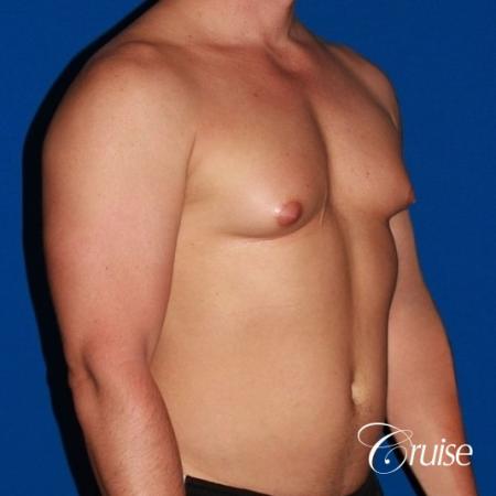 body builder with Gynecomastia puffy nipple - Before Image 4