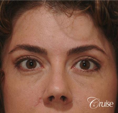 blepharoplasty specialist - After Image 1