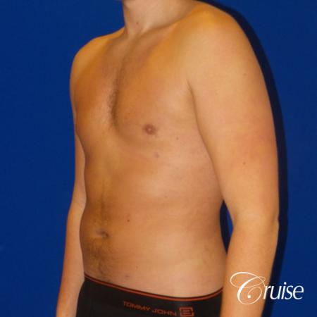 Best before and after lipo photos of guys - After Image 2
