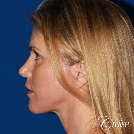best small anatomic implant photos - After Image 2