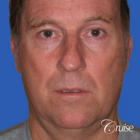 52 yr old male with medium square chin implant - Before Image 1