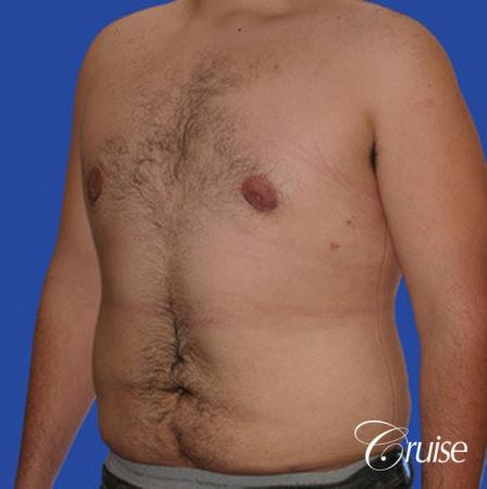 male liposuction abdomen flanks with Gynecomastia - After Image 3