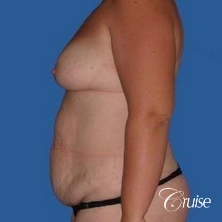 best mommy make over scars on massive weight loss silicone - Before Image 2
