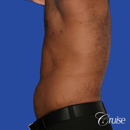 young adult with gyno gets gynecomastia surgery - After Image 2