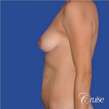 best mommy makeover incisions with saline implants - Before and After Image 2