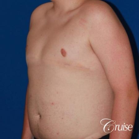 moderate gynecomastia with free nipple graft scar on teenager - After Image 2